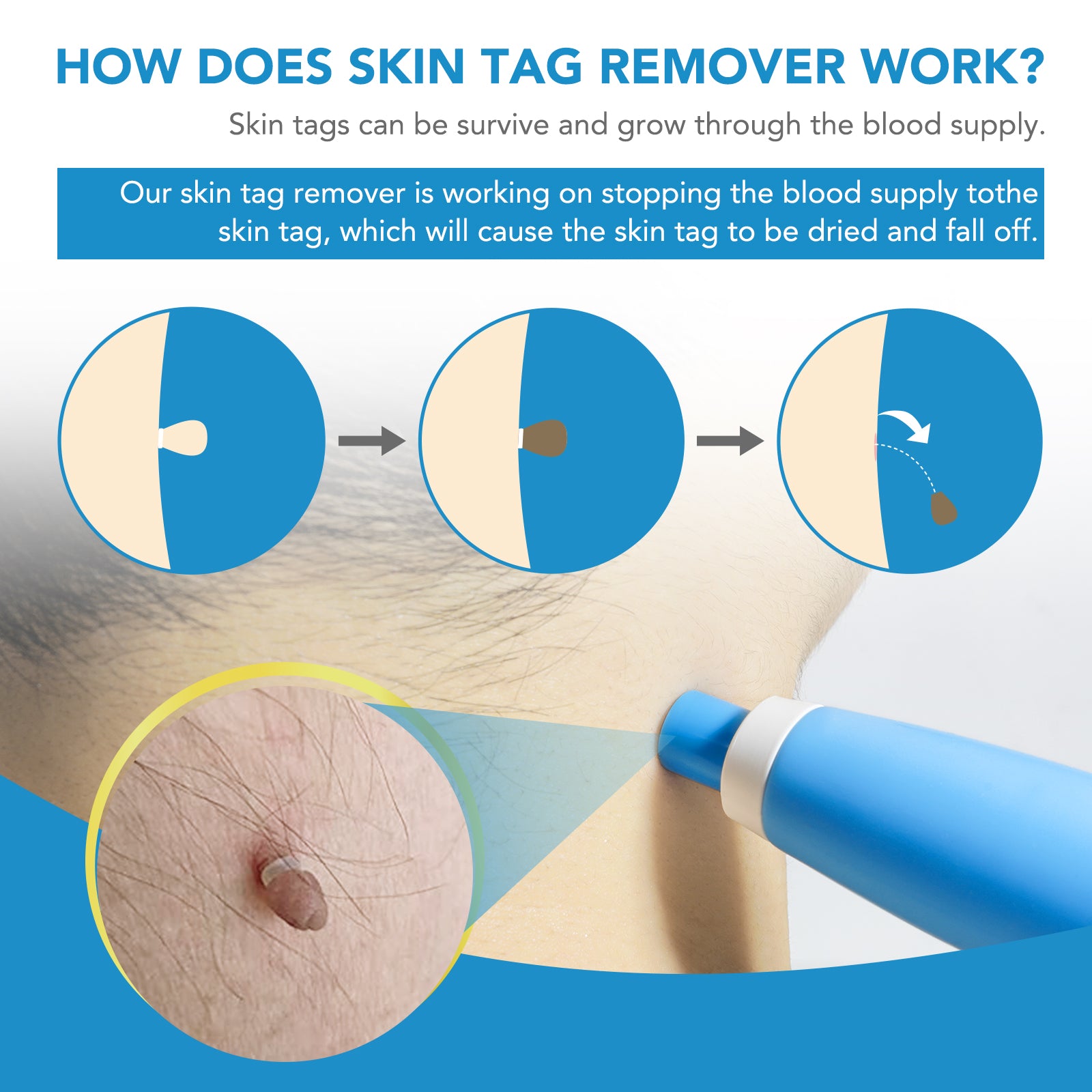 Micro Skin Tag Remover