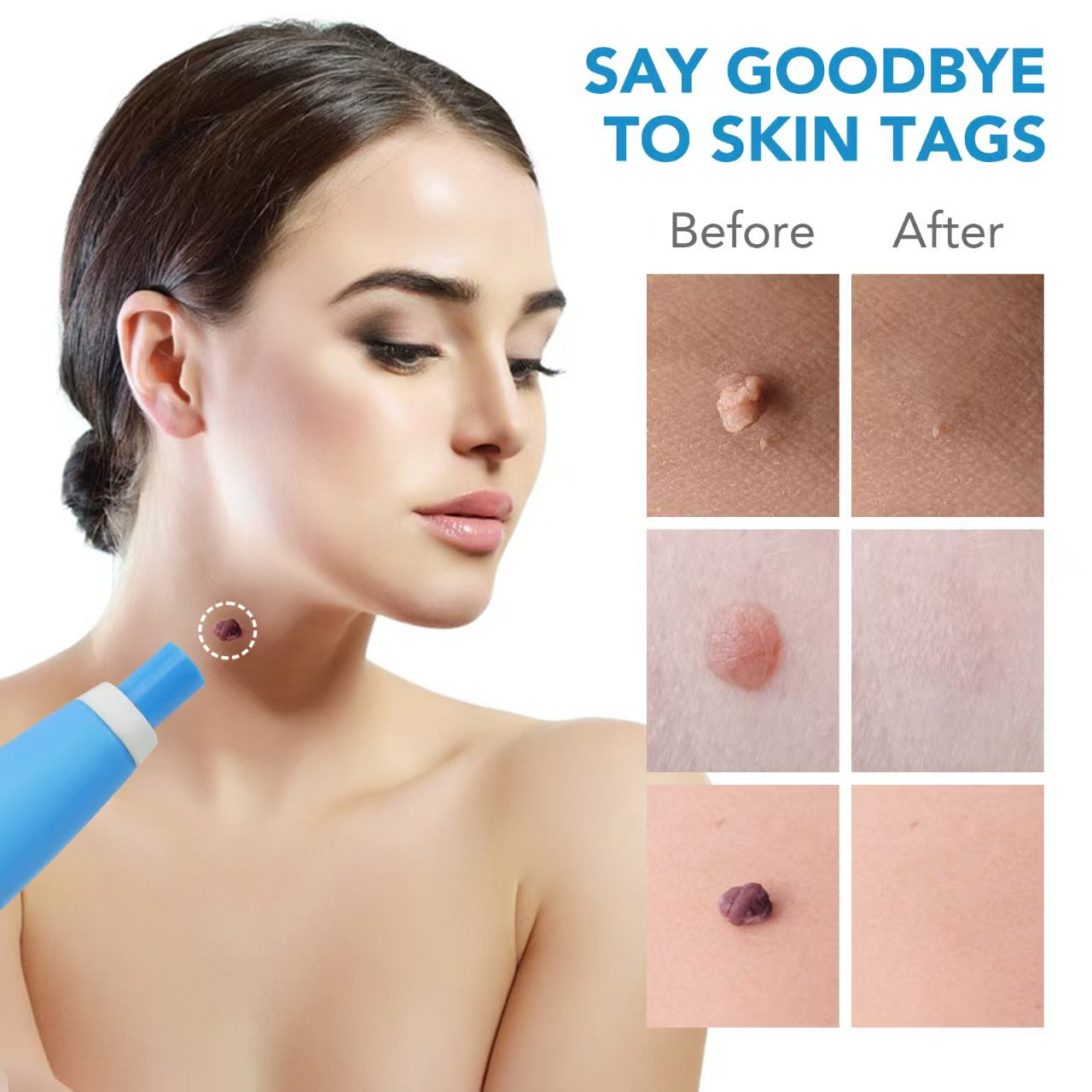 Micro Skin Tag Remover