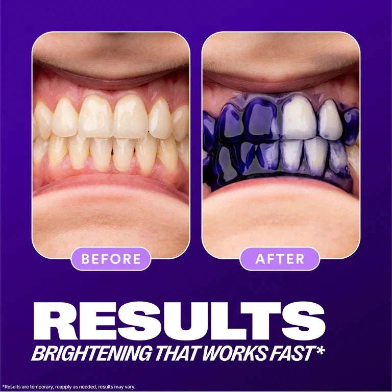 Smile Whitening Kit - Which is better decide for your self!