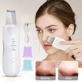 Electric Blackhead Scraper | Deep Clean. No Squeezing. No Marks.